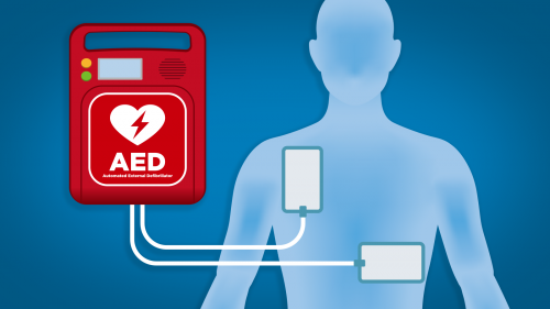 A simplified illustration of an Automated External Defibrillator (AED) with  electrode pads applied to a human figure.
