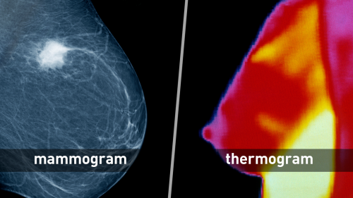 A mammogram (left) is an X-ray of the breast which, in this case, shows a cancerous mass in white. Thermography (right) produces an infrared image that shows the patterns of heat and blood flow on or near the surface of the body.