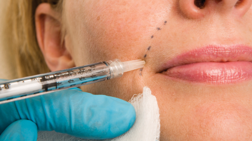 A closeup photo of woman receiving dermal (skin) wrinkle filler injections in her face.