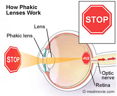 How phakic lenses work