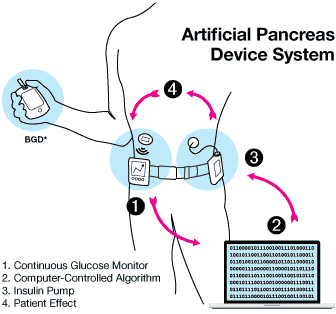 This image is a diagram showing each part that makes up an artificial pancreas.  It has items numbered one through four.  Item one is the continuous glucose monitor.  Item two is the computer-controlled algorithm.  Item three is the insulin pump.  Item four is the patient effect.