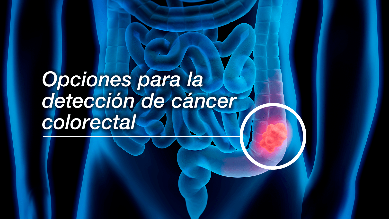 Cancer de colon bioneuroemocion, Cancer peritoneal biodescodificacion