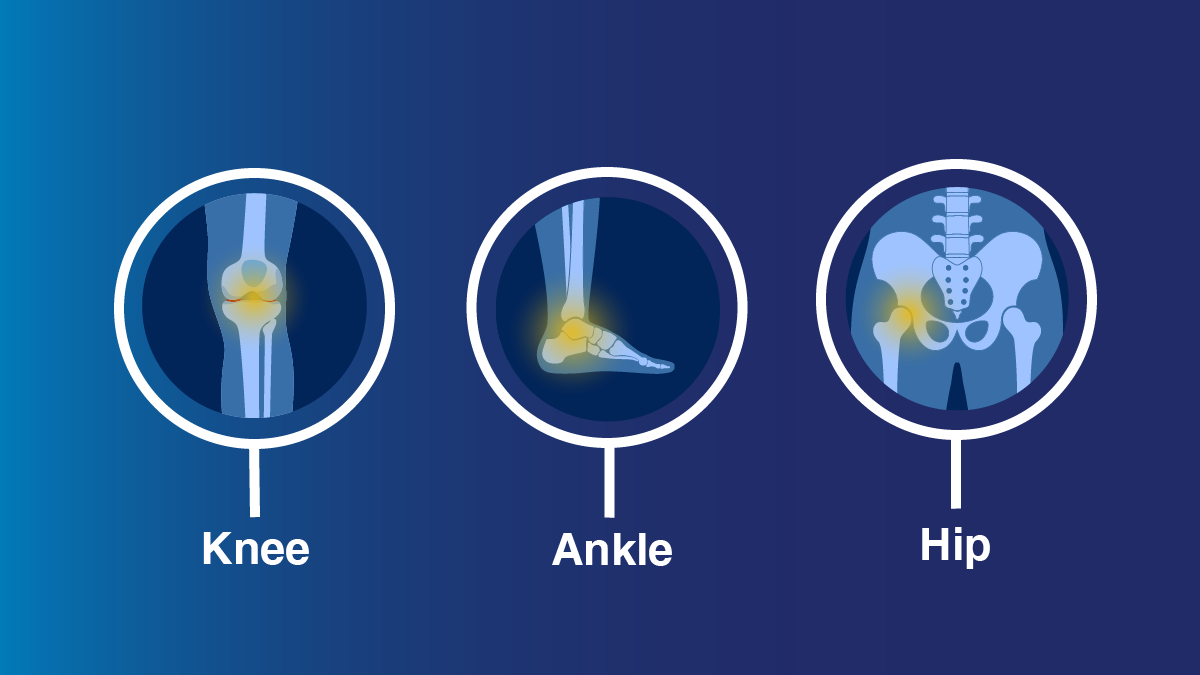 knee joint replacement devices