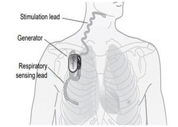 Drawing of where Inspire® Upper Airway Stimulation is implantanted in the chest.