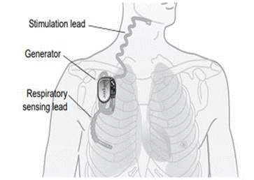 Desenarea locului în care Inspire® Upper Airway Stimulation este implantat în piept.