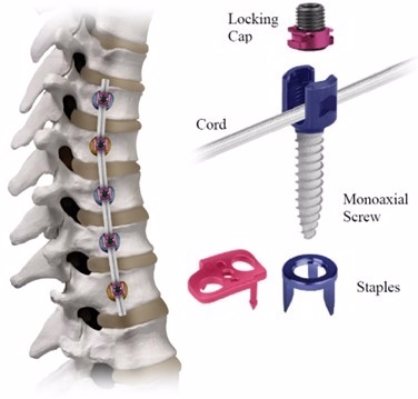 REFLECT Scoliosis Correction System in place on the vertebrae of the spine and close up view of labeled components. 
