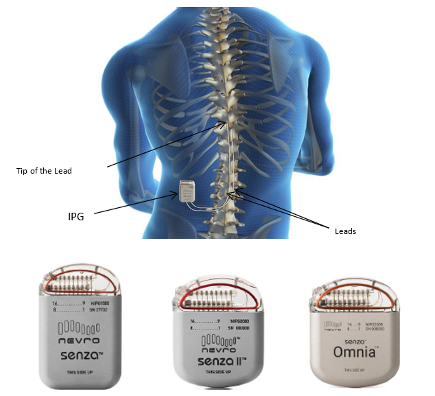 The Spinal Cord Stimulation System showing an illustration of a patient’s back and where the device is inserted. Also shown are the three types of Senza Spinal Cord Stimulation Systems.