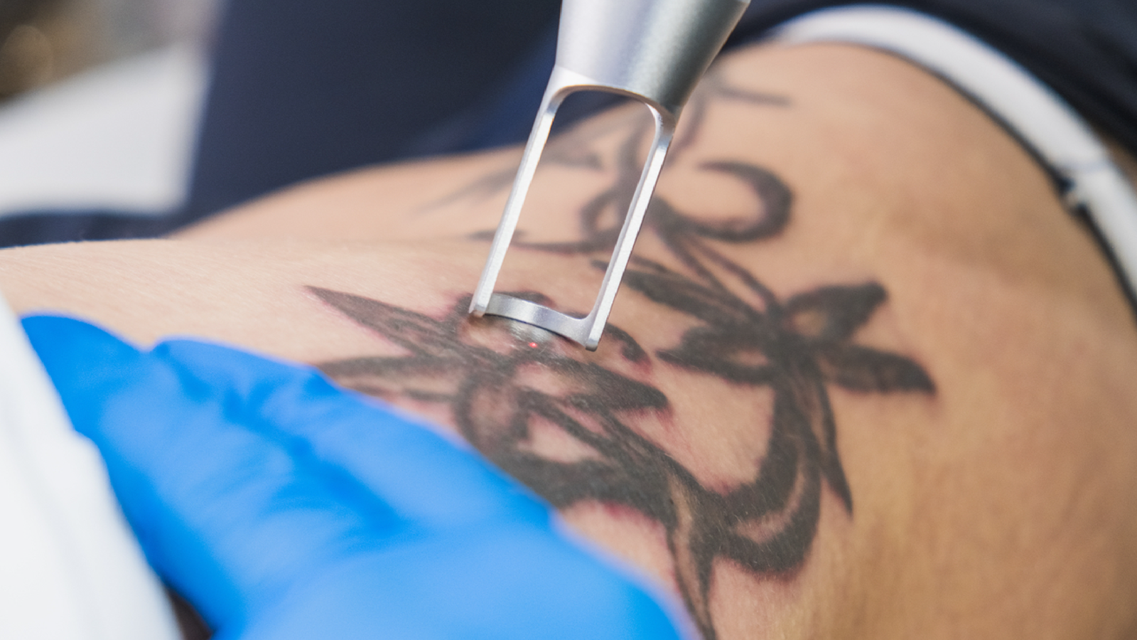 How to remove permanent tattoo at home using natural ways  Lets Get  Dressed