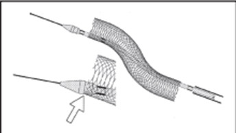 Vascular Stent