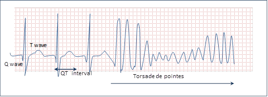 An ECG of a rapid abnormal heartbeat that produces a characteristic spiked pattern called torsade de pointes.