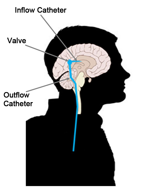 Cerebral Spinal Fluid (CSF) Shunt Systems