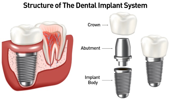 Parts of a dental implant