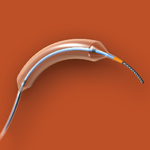 Image of the Abbott Vascular NC Trek RX Coronary Dilatation Catheter