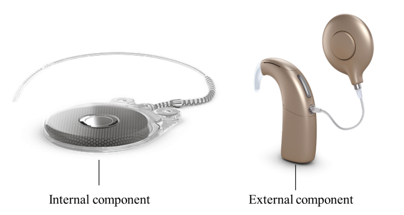 Neuro Cochlear Implant System – P200021