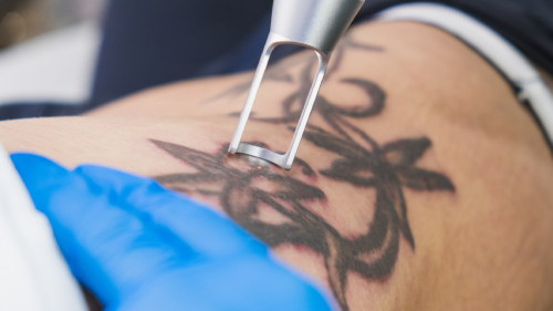 Close up of a person getting a tattoo removed from their arm.