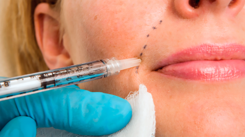 Woman with injection markings on face being injected with dermal filler with a needle