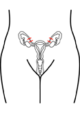 Cirugía de esterilización para mujeres