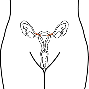 Sterilization Implant for Women