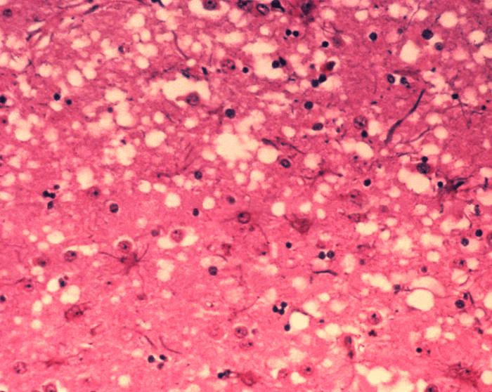 Slide of brain tissue - cow with BSE