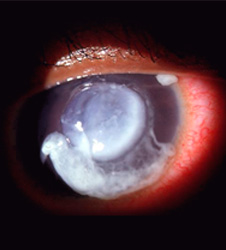 Close-up image of pseudomonas eye infection.