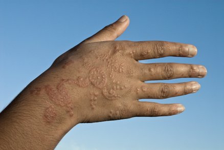 Allergic reaction to a henna tattoo on a man