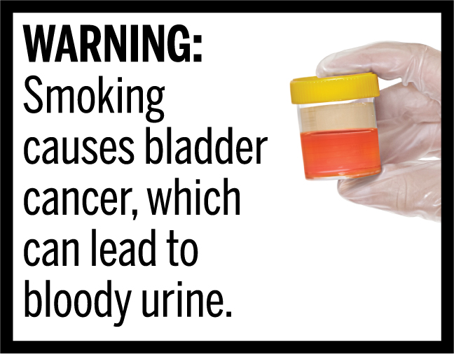 WARNING: Smoking causes bladder cancer, which can lead to bloody urine.